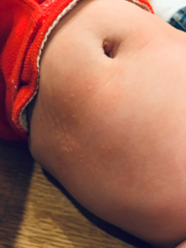 hives on the stomach of a baby